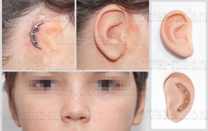 Приобретенный/врожденный дефект ушной раковины