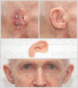 Приобретенный/врожденный дефект ушной раковины