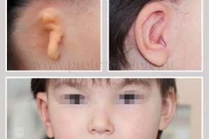 Приобретенный/врожденный дефект ушной раковины (микротия)