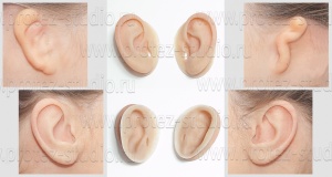 Приобретенный/врожденный дефект ушных раковин (микротия)