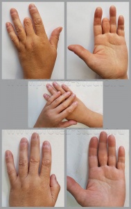 Фото протеза пальца