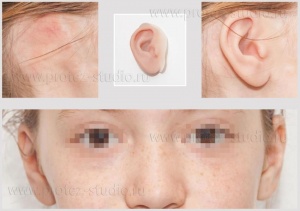 Приобретенный/врожденный дефект ушной раковины (микротия)