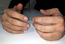Специалисты лаборатории Protez Studio изготовили протез пальца для молодого человека из Казани