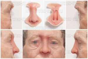 Дефект области носа