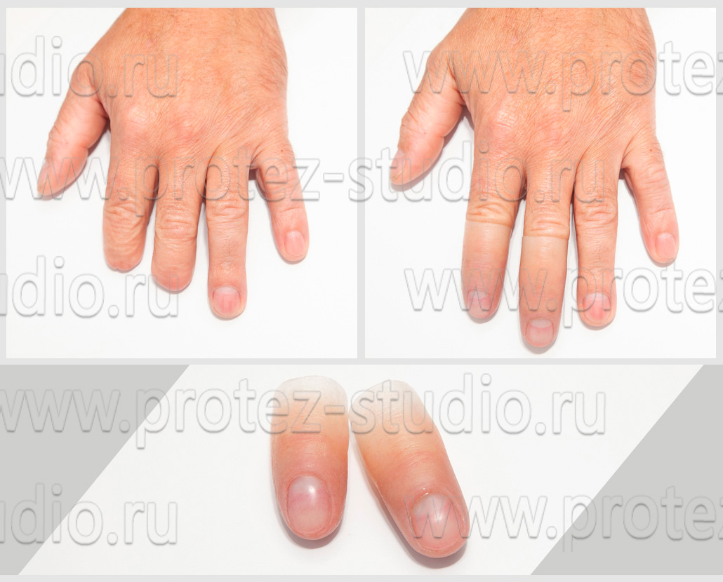 Протезы пальцев руки