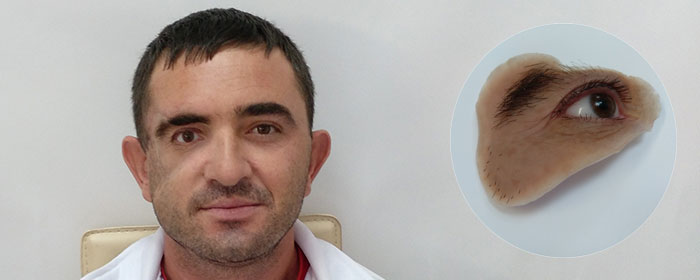 Новый лицевой протез для жителя Северной Осетии
