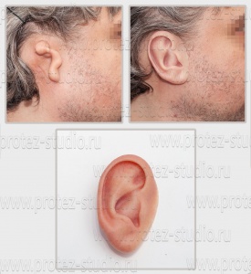 Приобретенный/врожденный дефект ушных раковин (микротия)