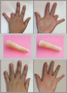 Протез пальца