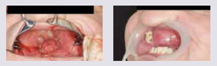 Второй этап сложного челюстно-лицевого эктопротезирования 