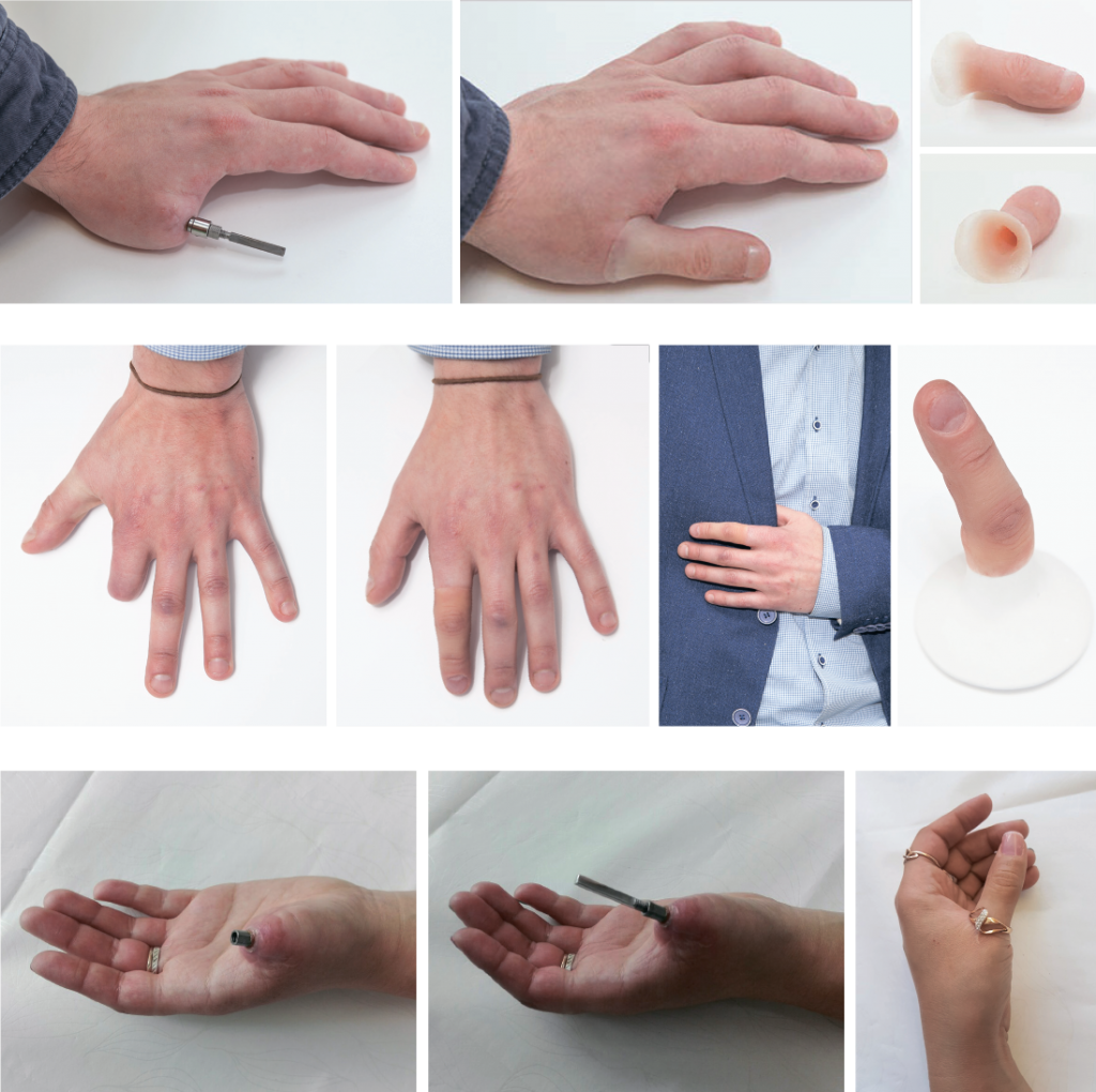как крепится протез пальца?