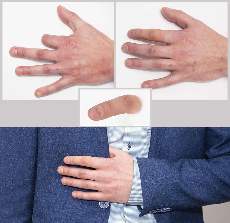 Пример протеза пальца