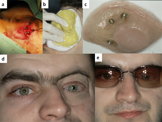 Глазной протез: a) установка имплантатов, b) снятие оттиска; c) шаровые атачменты и глазной протез; d) протез; e) пациент после реабилитации.